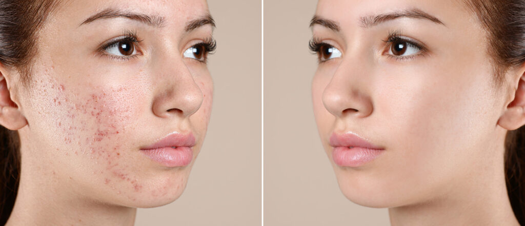 acne-treatment-before-after