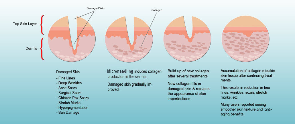 microneedling-process