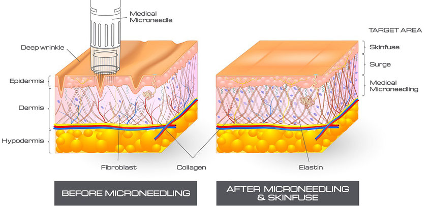 microneedling