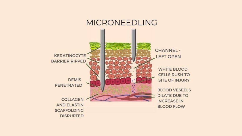 microneedling-process